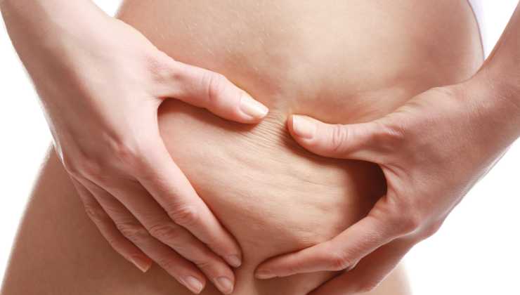 Perché si forma la cellulite