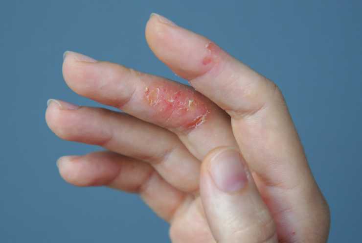 Le mani sono colpite dalla dermatite da prato