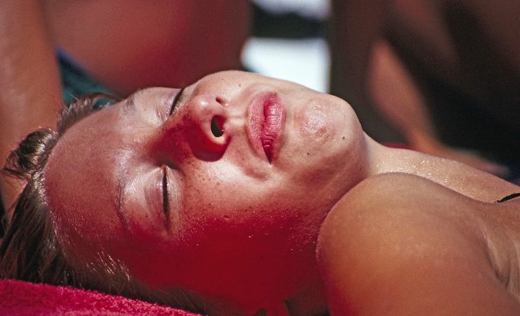 La scottatura solare può provocare intenso dolore